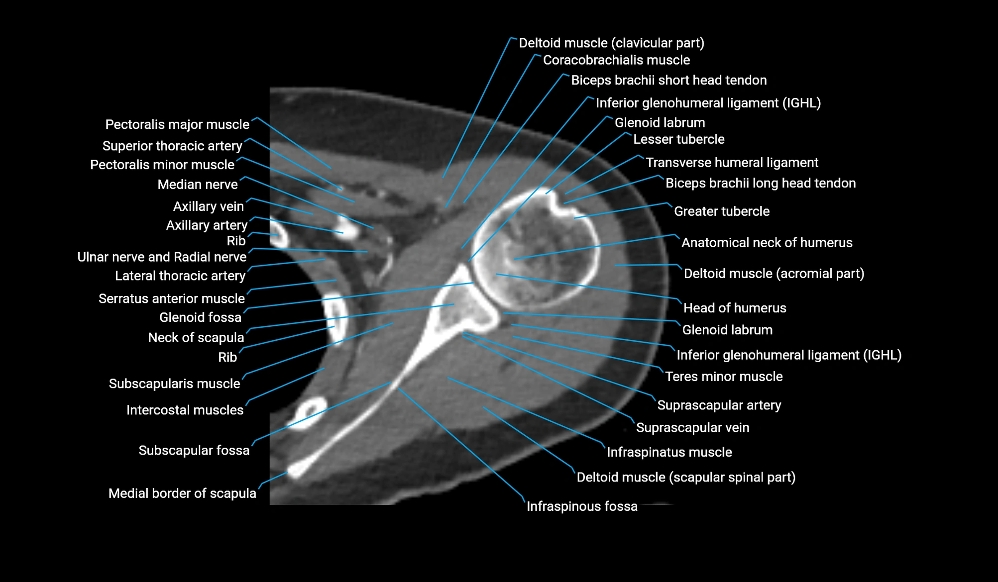 CT upper arm axial  cross sectional anatomy labelled radiology image -00096.webp